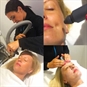 Cryotherapy Facial Luxury Experience in Kent